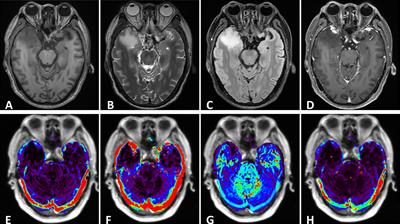 Contribution of advanced neuroimaging in diagnosis of cerebral syphilitic gumma: a case report